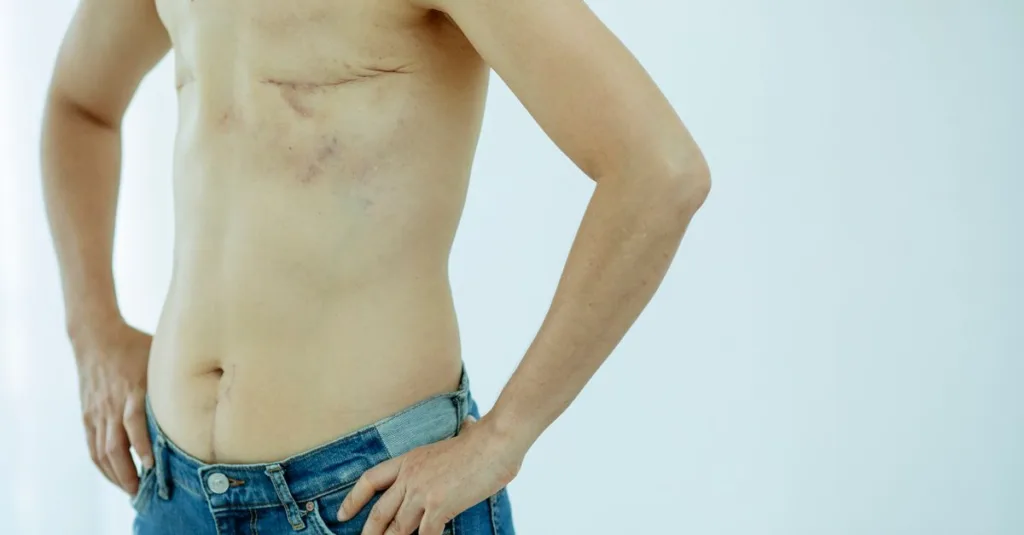 découvrez tout ce qu'il faut savoir sur la hernie inguinale : causes, symptômes, diagnostic et options de traitement pour mieux comprendre et gérer cette condition médicale courante.