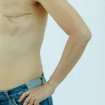découvrez tout ce qu'il faut savoir sur la hernie inguinale : causes, symptômes, diagnostic et options de traitement pour mieux comprendre et gérer cette condition médicale courante.