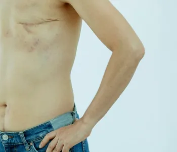 découvrez tout ce qu'il faut savoir sur la hernie inguinale : causes, symptômes, diagnostic et options de traitement pour mieux comprendre et gérer cette condition médicale courante.
