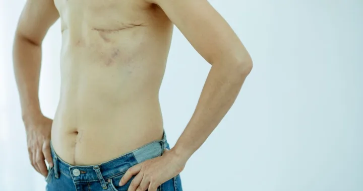 découvrez tout ce qu'il faut savoir sur la hernie inguinale : causes, symptômes, diagnostic et options de traitement pour mieux comprendre et gérer cette condition médicale courante.