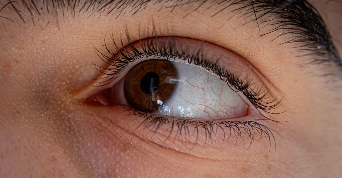 découvrez les symptômes d’une conjonctivite légère, ses causes possibles et les gestes simples pour soulager l’irritation des yeux.
