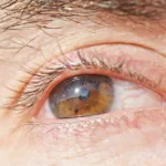 conjonctivite légère : découvrez les symptômes courants, les causes possibles et les gestes pour soulager l’irritation, ainsi que quand consulter.